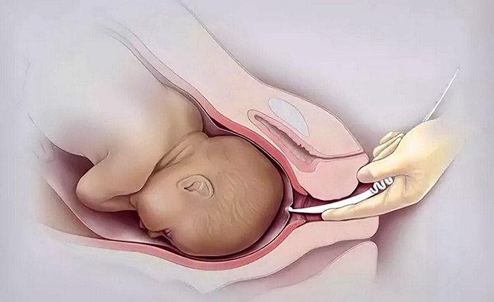 амниоскопия при беременности